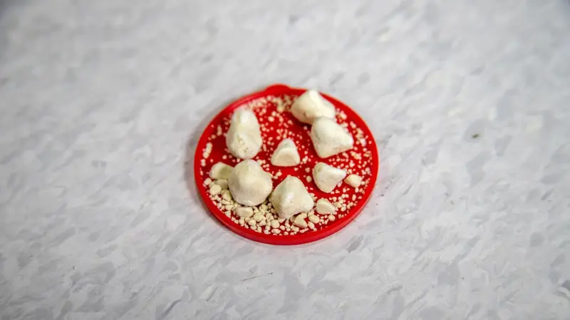 Kidney or Renal Stone Photo